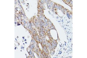 Immunohistochemistry of paraffin-embedded human colon carcinoma using L1 Rabbit pAb (ABIN6134555, ABIN6137248, ABIN6137250 and ABIN6215529) at dilution of 1:100 (40x lens). (ATG16L1 anticorps  (AA 200-300))