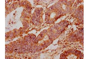 IHC image of ABIN7167509 diluted at 1:400 and staining in paraffin-embedded human colon cancer performed on a Leica BondTM system.