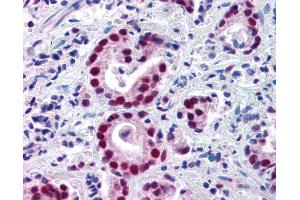 Anti-HDAC1 antibody IHC of human prostate carcinoma. (HDAC1 anticorps  (AA 466-482))