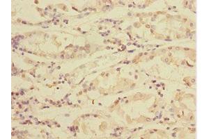 Immunohistochemistry of paraffin-embedded human gastric cancer using ABIN7172004 at dilution of 1:100 (TXNDC5 anticorps  (AA 1-324))