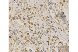 Immunohistochemistry of paraffin-embedded Human stomach cancer using BAK1 Polyclonal Antibody at dilution of 1:200 (40x lens). (BAK1 anticorps)