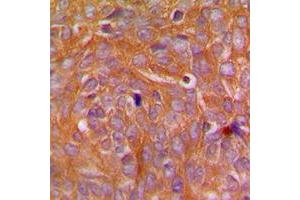 Immunohistochemical analysis of CARD14 staining in human breast cancer formalin fixed paraffin embedded tissue section. (CARD14 anticorps  (Center))