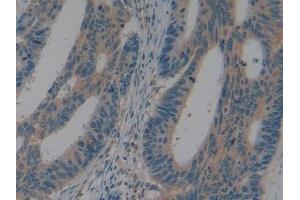 IHC-P analysis of Human Colorectal cancer Tissue, with DAB staining. (LAP anticorps  (AA 320-519))