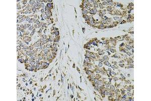 Immunohistochemistry of paraffin-embedded Human esophageal cancer using SELP Polyclonal Antibody at dilution of 1:100 (40x lens). (P-Selectin anticorps)