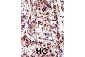 Formalin-fixed and paraffin-embedded human hepatocellular carcinoma tissue reacted with PACSIN1 polyclonal antibody  , which was peroxidase-conjugated to the secondary antibody, followed by DAB staining. (PACSIN1 anticorps  (Internal Region))