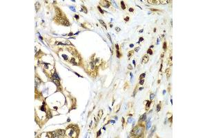 Immunohistochemistry of paraffin-embedded human liver cancer using TMOD4 antibody at dilution of 1:100 (x40 lens). (Tropomodulin 4 anticorps)
