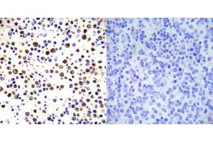 Immunohistochemical analysis of paraffin-embedded human malignant lymphoma tissue using Histone H3. (Histone H3.1 anticorps  (pThr3))