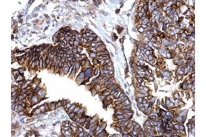 IHC-P Image IFITM1 antibody detects IFITM1 protein at cytosol and membrane on human ovarian carcinoma by immunohistochemical analysis. (IFITM1 anticorps)