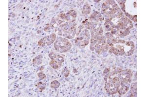 IHC-P Image Immunohistochemical analysis of paraffin-embedded NCIN87 xenograft, using Amphiphysin, antibody at 1:100 dilution. (Amphiphysin anticorps  (N-Term))