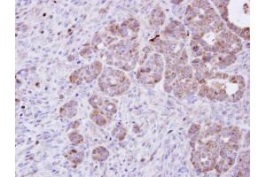 IHC-P Image Immunohistochemical analysis of paraffin-embedded NCIN87 xenograft, using Amphiphysin, antibody at 1:100 dilution. (Amphiphysin anticorps  (N-Term))