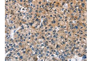 The image on the left is immunohistochemistry of paraffin-embedded Human liver cancer tissue using ABIN7128679(BPI Antibody) at dilution 1/50, on the right is treated with fusion protein. (BPI anticorps)