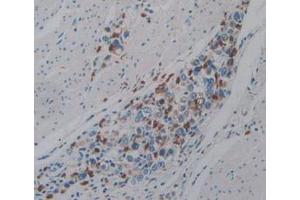IHC-P analysis of Human Stomach Cancer Tissue, with DAB staining. (PTPRQ anticorps  (AA 36-294))