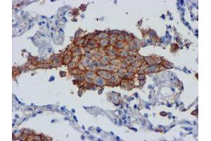 Immunohistochemical staining of paraffin-embedded Carcinoma of Human lung tissue using anti-CD80 mouse monoclonal antibody. (CD80 anticorps)