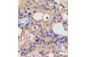 (ABIN6243855 and ABIN6577442) staining RK7 in human breast carcinoma sections by Immunohistochemistry (IHC-P - raformaldehyde-fixed, raffin-embedded sections). (PARK7/DJ1 anticorps  (C-Term))