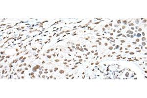 Immunohistochemistry of paraffin-embedded Human lung cancer tissue using SNRPA Polyclonal Antibody at dilution of 1:30(x200) (SNRPA1 anticorps)