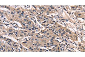 Immunohistochemistry of paraffin-embedded Human lung cancer using PEBP1 Polyclonal Antibody at dilution of 1:40 (PEBP1 anticorps)