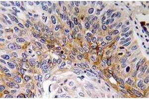 Immunohistochemistry (IHC) analyzes of Cardiotrophin-1 antibody in paraffin-embedded human lung carcinoma tissue. (Cardiotrophin 1 anticorps)