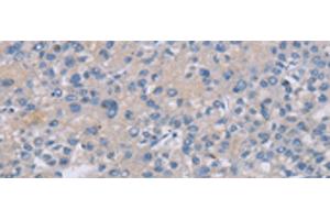 Immunohistochemistry of paraffin-embedded Human liver cancer tissue using CREBZF Polyclonal Antibody at dilution of 1:50(x200) (CREBZF anticorps)