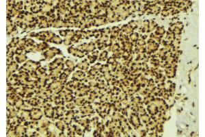 ABIN6269279 at 1/100 staining Human breast cancer tissue by IHC-P.