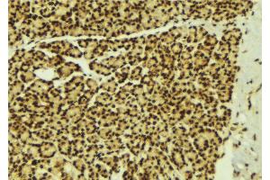ABIN6269279 at 1/100 staining Human breast cancer tissue by IHC-P. (STAT5B anticorps  (C-Term))