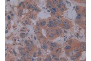 Detection of FBN1 in Human Breast cancer Tissue using Polyclonal Antibody to Fibrillin 1 (FBN1)