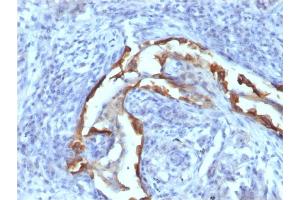 Formalin-fixed, paraffin-embedded human Lung Carcinoma stained with Cytokeratin 8 Mouse Monoclonal Antibody (SPM538) (KRT8 anticorps)