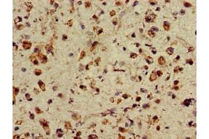 Immunohistochemistry of paraffin-embedded human glioma using ABIN7155470 at dilution of 1:100
