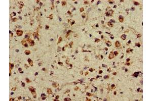 Immunohistochemistry of paraffin-embedded human glioma using ABIN7155470 at dilution of 1:100 (ASH1L anticorps  (AA 1906-2160))