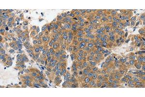 Immunohistochemistry of paraffin-embedded Human liver cancer tissue using GluR2 Polyclonal Antibody at dilution 1:70 (GRIA2 anticorps)