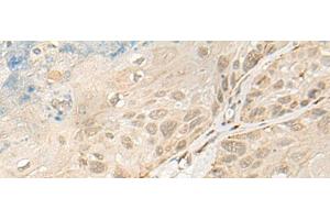 Immunohistochemistry of paraffin-embedded Human esophagus cancer tissue using OTX1 Polyclonal Antibody at dilution of 1:30(x200) (OTX1 anticorps)
