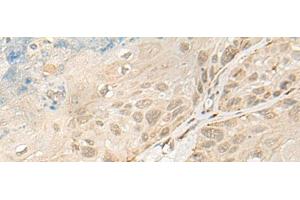 Immunohistochemistry of paraffin-embedded Human esophagus cancer tissue using OTX1 Polyclonal Antibody at dilution of 1:30(x200)