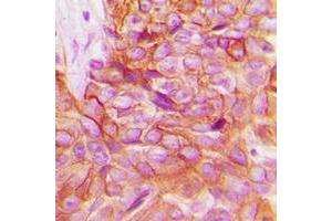 Immunohistochemical analysis of Alpha-adducin staining in human breast cancer formalin fixed paraffin embedded tissue section. (alpha Adducin anticorps  (C-Term))