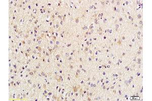 Formalin-fixed and paraffin embedded human brain glioblastoma labeled with Anti-Phospho-Beta-Catenin (Thr41/Ser45) Polyclonal Antibody, Unconjugated (ABIN683953) at 1:200 followed by conjugation to the secondary antibody and DAB staining (beta Catenin anticorps  (pSer45, pThr41))