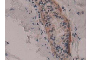 Detection of RPS6Ka1 in Human Breast cancer Tissue using Polyclonal Antibody to Ribosomal Protein S6 Kinase Alpha 1 (RPS6Ka1) (RPS6KA1 anticorps  (AA 62-321))