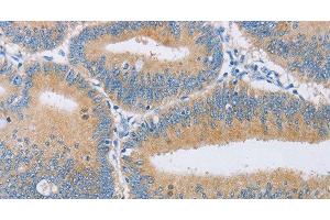 Immunohistochemistry of paraffin-embedded Human colon cancer tissue using CENPE Polyclonal Antibody at dilution 1:50 (CENPE anticorps)