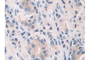 Detection of CaN in Human Prostate cancer Tissue using Polyclonal Antibody to Calcineurin (CaN)