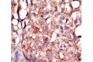 IHC analysis of FFPE human breast carcinoma tissue stained with the RIPK4 antibody (RIPK4 anticorps  (AA 802-832))