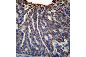 immunohistochemistry analysis in formalin fixed and paraffin embedded human ovarian carcinoma reacted with HOXB3 / HOX2G Antibody (Center) followed  which was peroxidase-conjugated to the secondary antibody, followed by DAB staining.