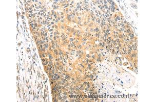 Immunohistochemistry of Human esophagus cancer using CAPN1 Polyclonal Antibody at dilution of 1:20 (CAPNL1 anticorps)