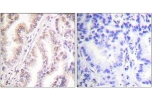 Immunohistochemistry analysis of paraffin-embedded human lung carcinoma tissue, using PIAS1 Antibody. (PIAS1 anticorps  (AA 10-59))