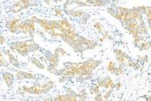 Immunohistochemistry of paraffin embedded human breast cancer using Epl4 (ABIN7073843) at dilution of 1:2000 (400x lens) (EFNA4 anticorps)