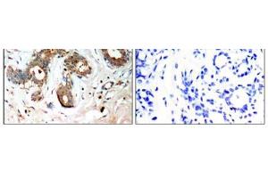 Immunohistochemical analysis of paraffin-embedded human breast carcinoma tissue, using 14-3-3 ζ (Phospho-Ser58) antibody (E011181). (14-3-3 zeta anticorps  (pSer58))
