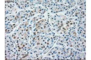 Immunohistochemical staining of paraffin-embedded Carcinoma of liver tissue using anti-SIGLEC9mouse monoclonal antibody. (SIGLEC9 anticorps)