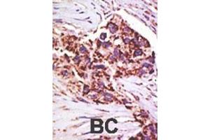 Formalin-fixed and paraffin-embedded human cancer tissue reacted with the primary antibody, which was peroxidase-conjugated to the secondary antibody, followed by DAB staining.