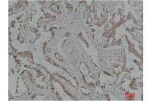 Immunohistochemistry (IHC) analysis of paraffin-embedded Human Breast Carcinoma using MEK-5 Polyclonal Antibody. (MAP2K5 anticorps)