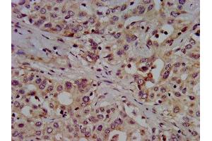IHC image of ABIN7155172 diluted at 1:500 and staining in paraffin-embedded human liver cancer performed on a Leica BondTM system.