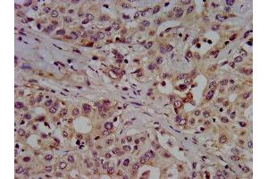 IHC image of ABIN7155172 diluted at 1:500 and staining in paraffin-embedded human liver cancer performed on a Leica BondTM system. (SLC7A1 anticorps  (AA 430-492))