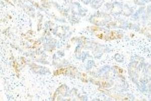 Immunohistochemistry analysis of paraffin-embedded Human ovarian cancer using Collagen X (ABIN7073549) at dilution of 1: 2000
