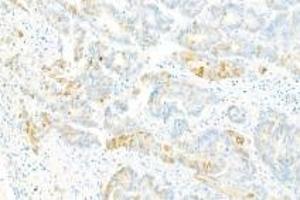 Immunohistochemistry analysis of paraffin-embedded Human ovarian cancer using Collagen X (ABIN7073549) at dilution of 1: 2000 (COL10 anticorps)