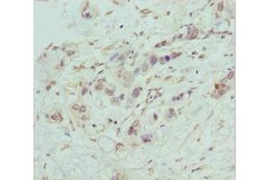 Immunohistochemistry of paraffin-embedded human pancreatic cancer using ABIN7148459 at dilution of 1:100 (COG5 anticorps  (AA 1-260))